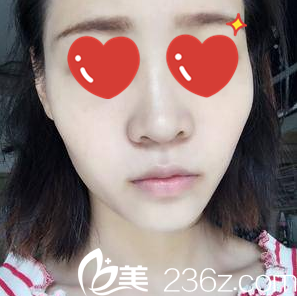 在美艺做鼻整形术前照 在美艺做鼻整形术前照