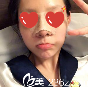 在美艺做假体隆鼻+脂肪填充面部第三天 在美艺做假体隆鼻+脂肪填充面部第三天