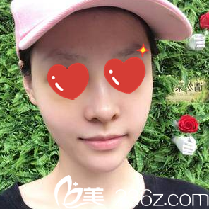 假体隆鼻+自体脂肪填充面部一周拆线 假体隆鼻+自体脂肪填充面部一周拆线