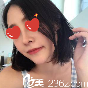 美艺自体脂肪填充+隆鼻一个月 美艺自体脂肪填充+隆鼻一个月