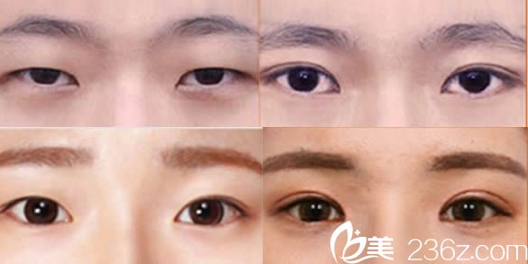 韩国然美之整形医院李东勋院长双眼皮案例图