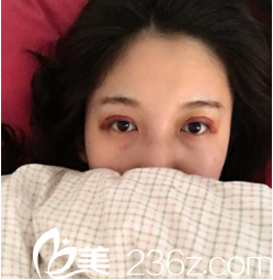 宁夏华美双眼皮术后6天 宁夏华美双眼皮术后6天