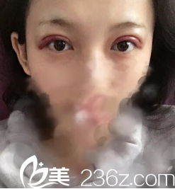 手术第二天 手术第二天