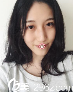 何林全切双眼皮术后13天 何林全切双眼皮术后13天