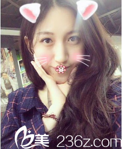 宁夏华美何林双眼皮术后27天 宁夏华美何林双眼皮术后27天