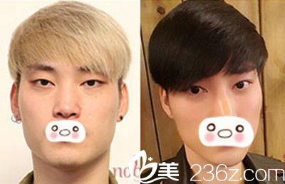 面部轮廓+双眼皮手术对比效果 面部轮廓+双眼皮手术对比效果