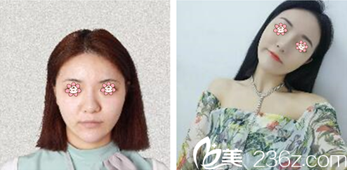 李源锡院长面部埋线提升案例 李源锡院长面部埋线提升案例