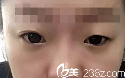 手术前照片 手术前照片