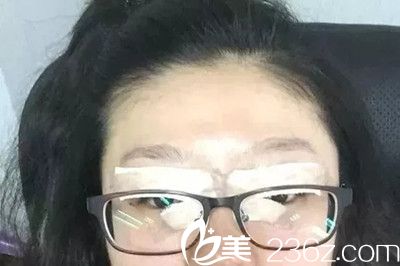 双眼皮手术后1天 双眼皮手术后1天