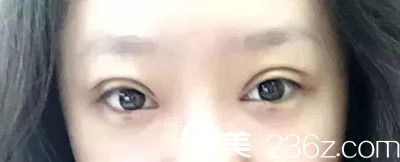 双眼皮拆线了 双眼皮拆线了