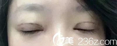 术后8天 术后8天