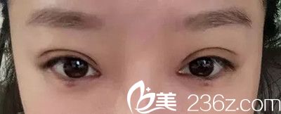 吴伟林医生双眼皮手术案例 吴伟林医生双眼皮手术案例