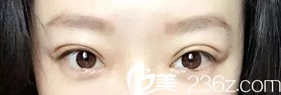 双眼皮术后15天恢复效果 双眼皮术后15天恢复效果