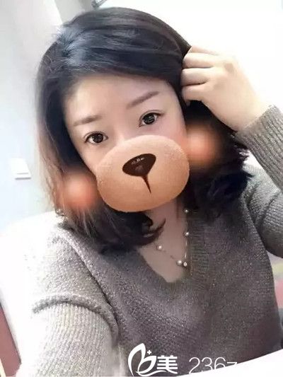 三个月前在九江星瑞美整形医院做了双眼皮手术，给大家分享下恢复情况吧