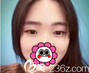 在北京美憬做双眼皮前样子 在北京美憬做双眼皮前样子