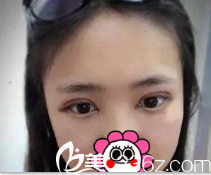 在北京美憬做切开双眼皮开眼角第4天效果 在北京美憬做切开双眼皮开眼角第4天效果