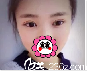 北京美憬闫迎军双眼皮案例 北京美憬闫迎军双眼皮案例