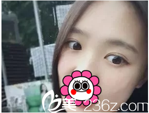 北京美憬闫迎军双眼皮案例第37天效果 北京美憬闫迎军双眼皮案例第37天效果