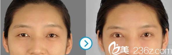 韩国ROCOCO双眼皮案例 韩国ROCOCO双眼皮案例