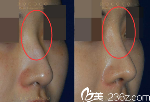 韩国ROCOCO隆鼻案例 韩国ROCOCO隆鼻案例