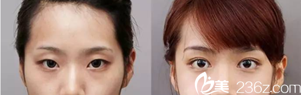 韩国ROCOCO医院金相虎切开双眼皮案例 韩国ROCOCO医院金相虎切开双眼皮案例