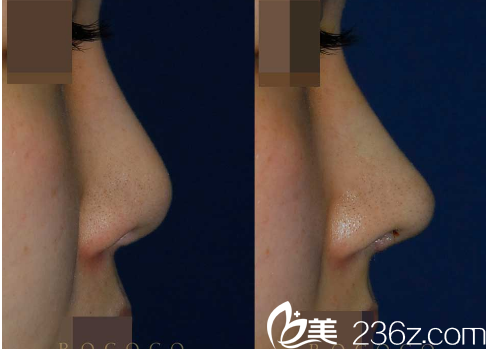 韩国ROCOCO医院金相虎鼻综合案例 韩国ROCOCO医院金相虎鼻综合案例