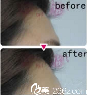 赵得媛脂肪填充额头真人案例