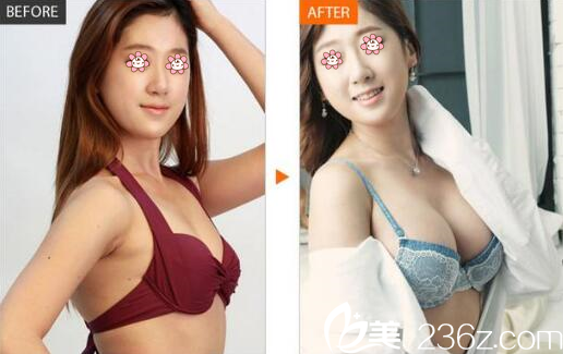 尹盛浩院长胸部整形案例 尹盛浩院长胸部整形案例