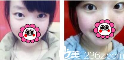 韩国姜元景整形外科姜元景双眼皮真人案例术前照 韩国姜元景整形外科姜元景双眼皮真人案例术前照