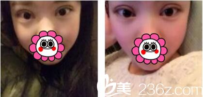 韩国姜元景整形外科姜元景双眼皮真人案例术后第三天 韩国姜元景整形外科姜元景双眼皮真人案例术后第三天