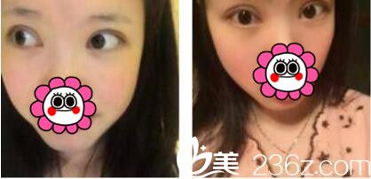 韩国姜元景整形外科姜元景双眼皮真人案例术后第七天 韩国姜元景整形外科姜元景双眼皮真人案例术后第七天