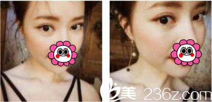 韩国姜元景整形外科姜元景双眼皮真人案例术后二十一天 韩国姜元景整形外科姜元景双眼皮真人案例术后二十一天