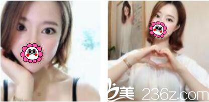 一个月前去韩国姜元景做了双眼皮，没想到姜元景技术真的不是吹的恢复的特别自然