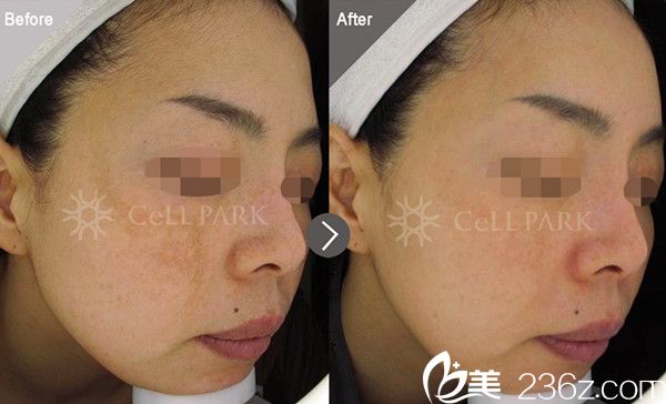 20180806_1533536672425235.jpg 斑点治疗.jpg