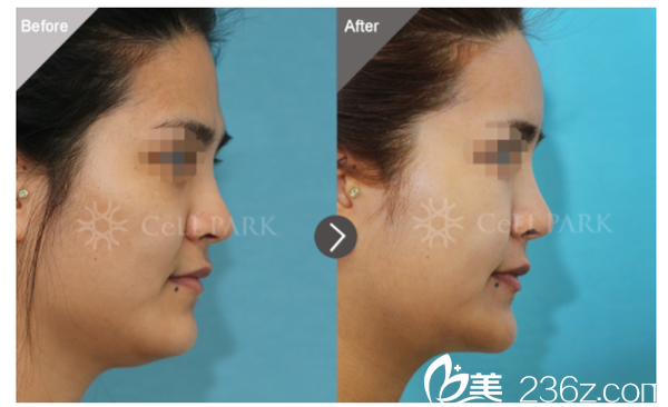 20180806_1533536686555301.png 额头脂肪移植,下巴溶脂.png