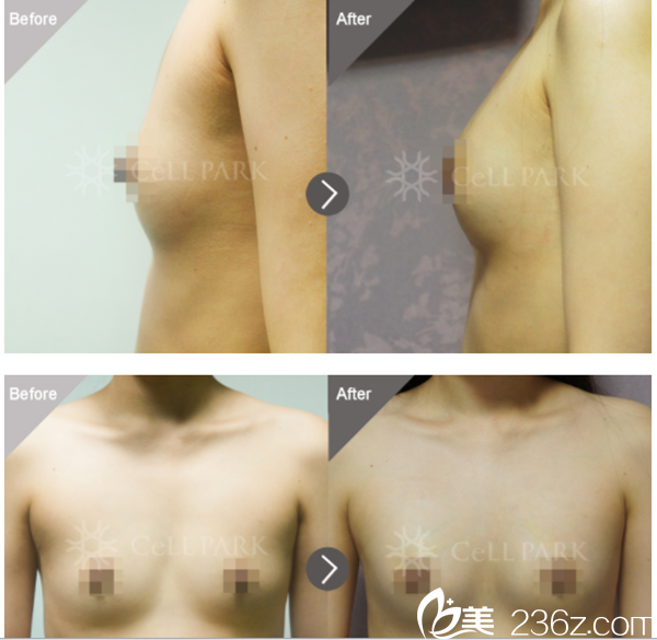 20180806_1533536698672542.png 自体脂肪丰胸.png