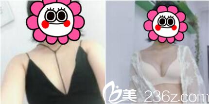 上海百达丽医疗美容门诊部自体脂肪隆胸真人案例