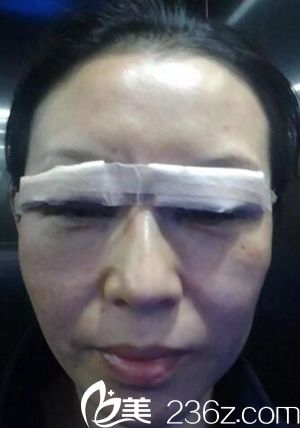 鹤壁美林苑做双眼皮和开眼角手术