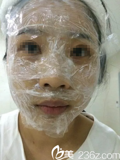 皮秒祛斑术前敷麻药过程中 皮秒祛斑术前敷麻药过程中