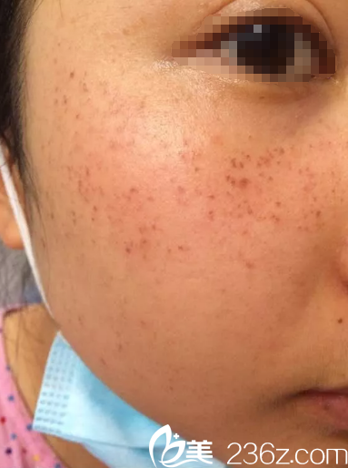 刚做完皮秒祛斑面部有些发红 刚做完皮秒祛斑面部有些发红