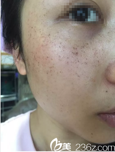 皮秒祛斑术后三天开始掉痂 皮秒祛斑术后三天开始掉痂