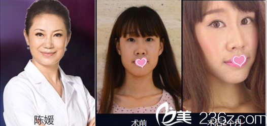 北京美莱陈媛眼综合瘦脸<span style= 北京美莱陈媛眼综合瘦脸<span style=