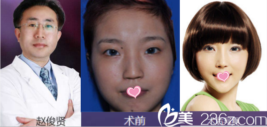 北京美莱赵峻贤双眼皮<span style= 北京美莱赵峻贤双眼皮<span style=