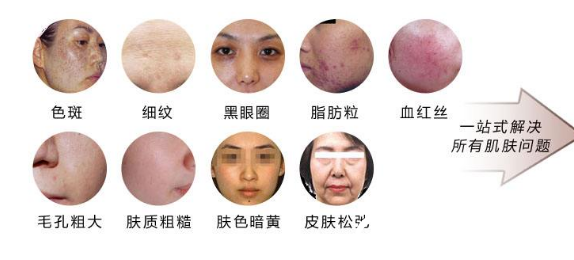 光子嫩肤治疗的范围有痘印 收缩毛孔 光子嫩肤治疗的范围有痘印 收缩毛孔