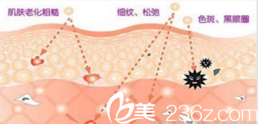 光子嫩肤的方法 光子嫩肤的方法