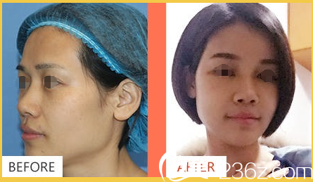 自体脂肪面部填充术前术后对比