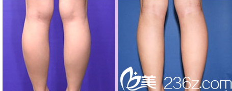 韩国Ree&Ahn Clinic医院注射瘦腿案例 韩国Ree&Ahn Clinic医院注射瘦腿案例