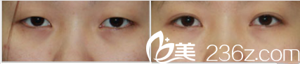 韩国Ree&Ahn Clinic医院双眼皮案例 韩国Ree&Ahn Clinic医院双眼皮案例