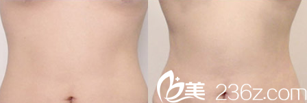 韩国Ree&Ahn Clinic医院腹部吸脂案例 韩国Ree&Ahn Clinic医院腹部吸脂案例