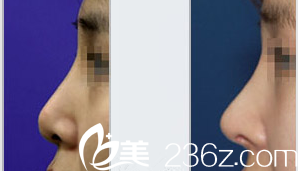 韩国Ree&Ahn Clinic医院隆鼻案例 韩国Ree&Ahn Clinic医院隆鼻案例